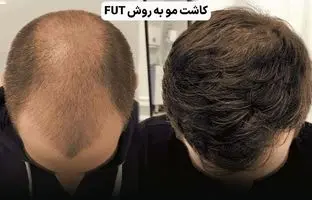 کاشت مو چند روش دارد؟ راهنمای انتخاب بهترین روش برای شما