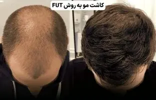 کاشت مو چند روش دارد؟ راهنمای انتخاب بهترین روش برای شما