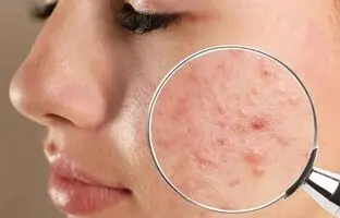 علت اصلی جوش چرکی چیست ؟ ؛ درمان خانگی جوش های چرکی و دردناک