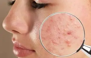 علت اصلی جوش چرکی چیست ؟ ؛ درمان خانگی جوش های چرکی و دردناک