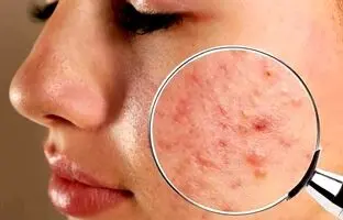 علت اصلی جوش چرکی چیست ؟ ؛ درمان خانگی جوش های چرکی و دردناک