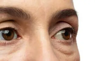 علت ایجاد پف زیر چشم چیست؟/ ۶ روش سریع برای از بین بردن پف زیر چشم