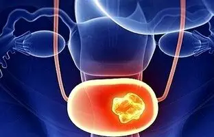 دلایل ابتلا به سنگ مثانه