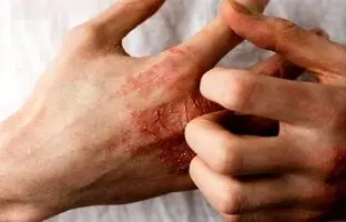 بهترین راهکارها برای جلوگیری از خشکی پوست