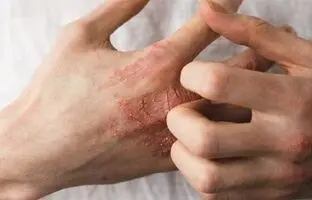 بهترین راهکارها برای جلوگیری از خشکی پوست