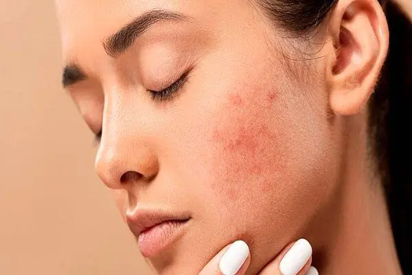 چند درمان خانگی برای رفع فوری جوش‌های صورت