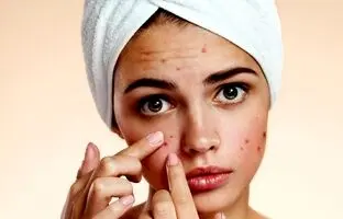 بهترین کرم های ضد جوش و آکنه خارجی