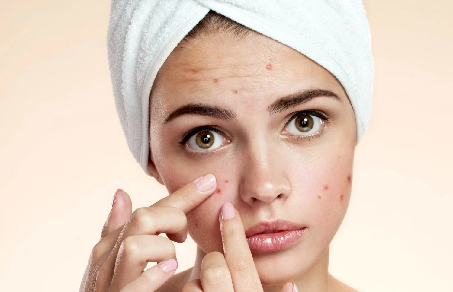 بهترین کرم های ضد جوش و آکنه خارجی