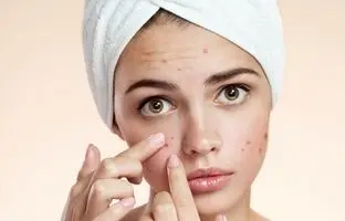 بهترین کرم های ضد جوش و آکنه خارجی