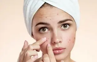 بهترین کرم های ضد جوش و آکنه خارجی
