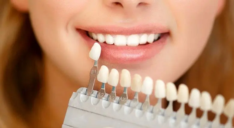 نحوه انتخاب بهترین دندانپزشک زیبایی کامپوزیت ونیر