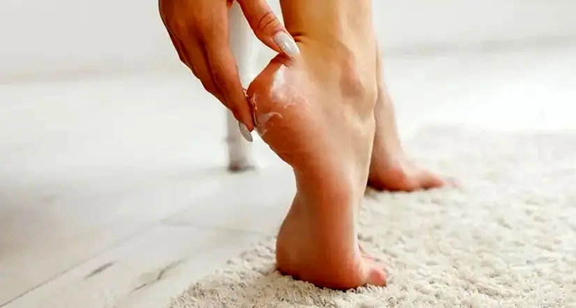 با این ۵ کرم معجزه آسا از شر ترک پا خلاص شوید!