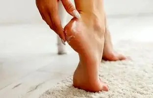 با این ۵ کرم معجزه آسا از شر ترک پا خلاص شوید!