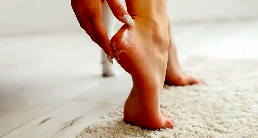 با این ۵ کرم معجزه آسا از شر ترک پا خلاص شوید!