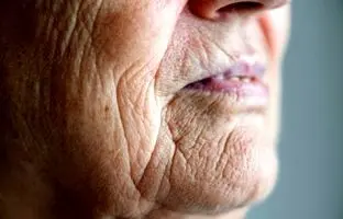 علل خاص چروک صورت؛ پوست چه افرادی زودتر پیر و چروک می‌شود؟