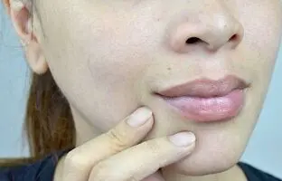 علل و بهترین راههای خانگی درمان سیاهی پشت لب + ماسک گیاهی