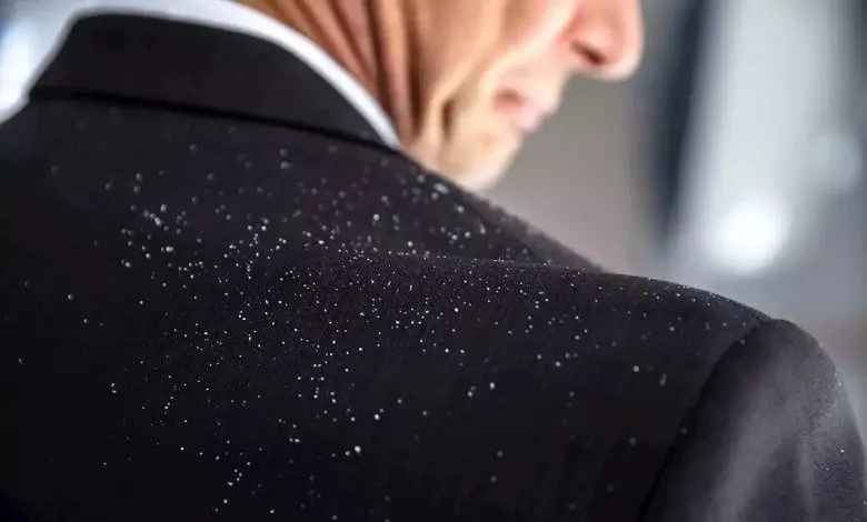 درمان خانگی شوره سر با 3 راه حل خانگی