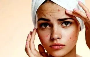 چگونه از شر جوش بعد از اپیلاسیون خلاص شویم؟
