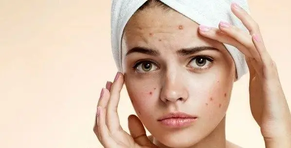 چگونه از شر جوش بعد از اپیلاسیون خلاص شویم؟