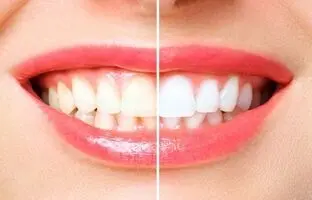 چطوری از شر زردی دندان هایمان خلاص شویم؟ از روش‌های درمانی تا راه‌حل‌های خانگی