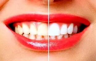 چطوری از شر زردی دندان هایمان خلاص شویم؟ از روش‌های درمانی تا راه‌حل‌های خانگی