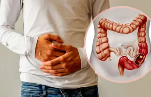 علائم اولیه و هشداردهنده سرطان روده بزرگ چیست؟ پیشگیری و راه‌های درمان