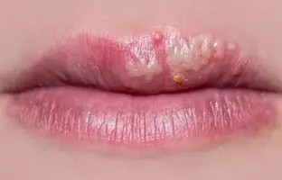 چطور از شر «تبخال» خلاص شویم؟