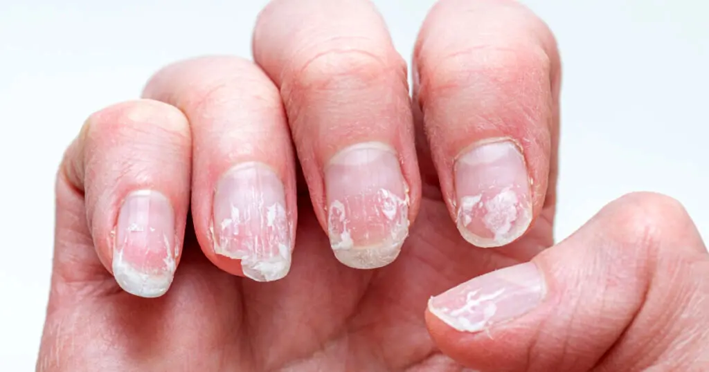 9 دلیل پوسته پوسته شدن ناخن و راه حل رفع این مشکل