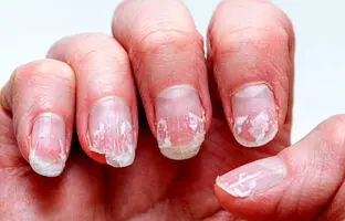 9 دلیل پوسته پوسته شدن ناخن و راه حل رفع این مشکل