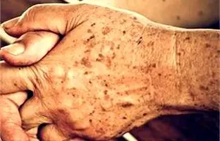 لکه های پوستی از کجا می آیند؟