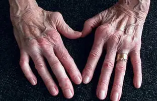همه چیز درباره روماتیسم: از علل و علائم تا روش‌های کنترل و درمان