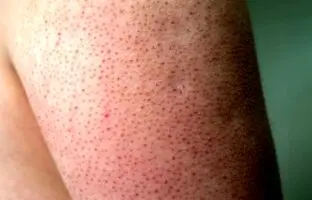 پوست مرغی چیست و چگونه درمان می‌شود؟