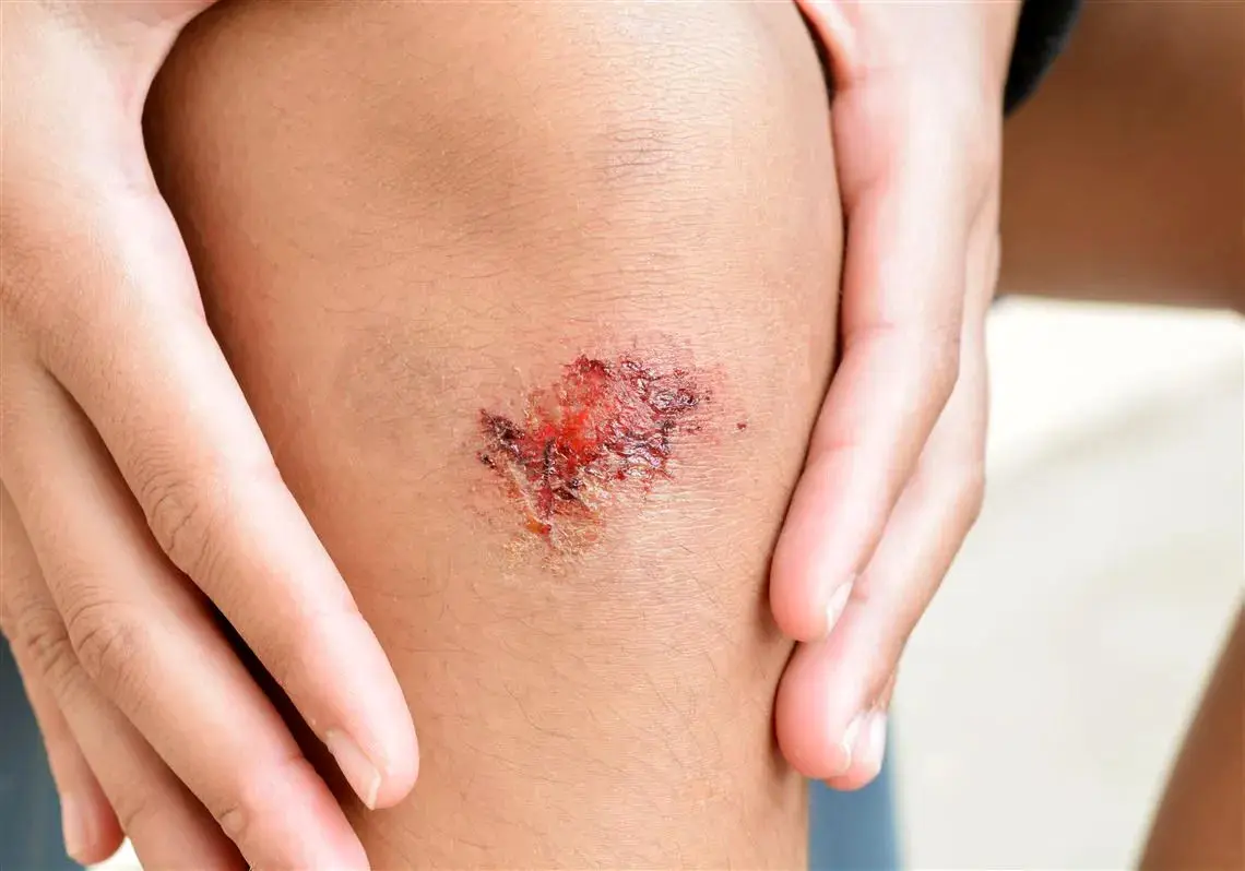 زخمی که التیام نمی‌یابد: هشدارهایی درباره کندن زخم خشک شده!