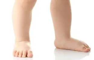 صافی کف پا در کودکان و عوامل موثر بر ایجاد آن