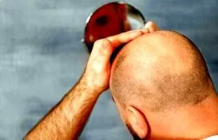 علت طاسی سر چیست؟ آیا راهی برای پیشگیری و درمان طاسی وجود دارد؟