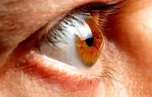 عامل مهم قوز قرنیه؛ این کار را نکنید