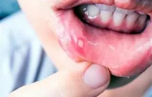 چرا آفت دهان می‌زنیم و چگونه آن را درمان کنیم؟
