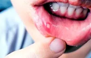 چرا آفت دهان می‌زنیم و چگونه آن را درمان کنیم؟