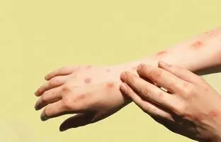 آبله میمونی چگونه منتقل می‌شود؟