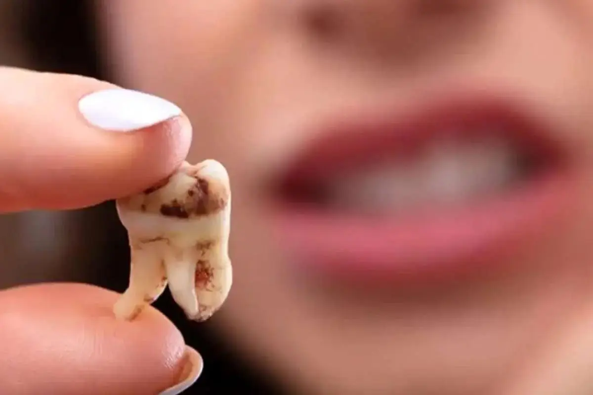  چرا دندان‌ها زود به زود پوسیده می‌شوند؟ 