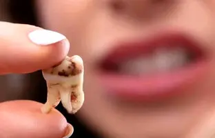  چرا دندان‌ها زود به زود پوسیده می‌شوند؟ 