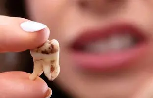  چرا دندان‌ها زود به زود پوسیده می‌شوند؟ 