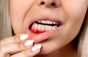مصرف این نوشیدنی‌ها سبب خونریزی لثه می‌شود