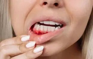 مصرف این نوشیدنی‌ها سبب خونریزی لثه می‌شود
