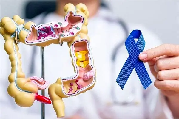 کدام افراد در معرض خطر سرطان روده هستند؟