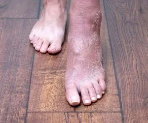 بهترین راه برای کمک به پاهایی که ورم میکنند