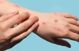 راهکار‌های پیشگیری از ابتلا به آبله میمونی 