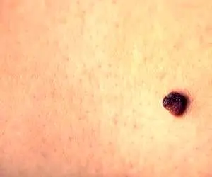 همه آنچه که باید درباره خال و روش برداشتن آن بدانید