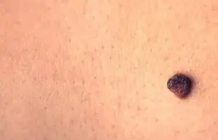 همه آنچه که باید درباره خال و روش برداشتن آن بدانید