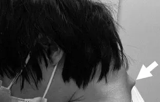 بیماری سندرم سر افتاده چه علائمی دارد؟